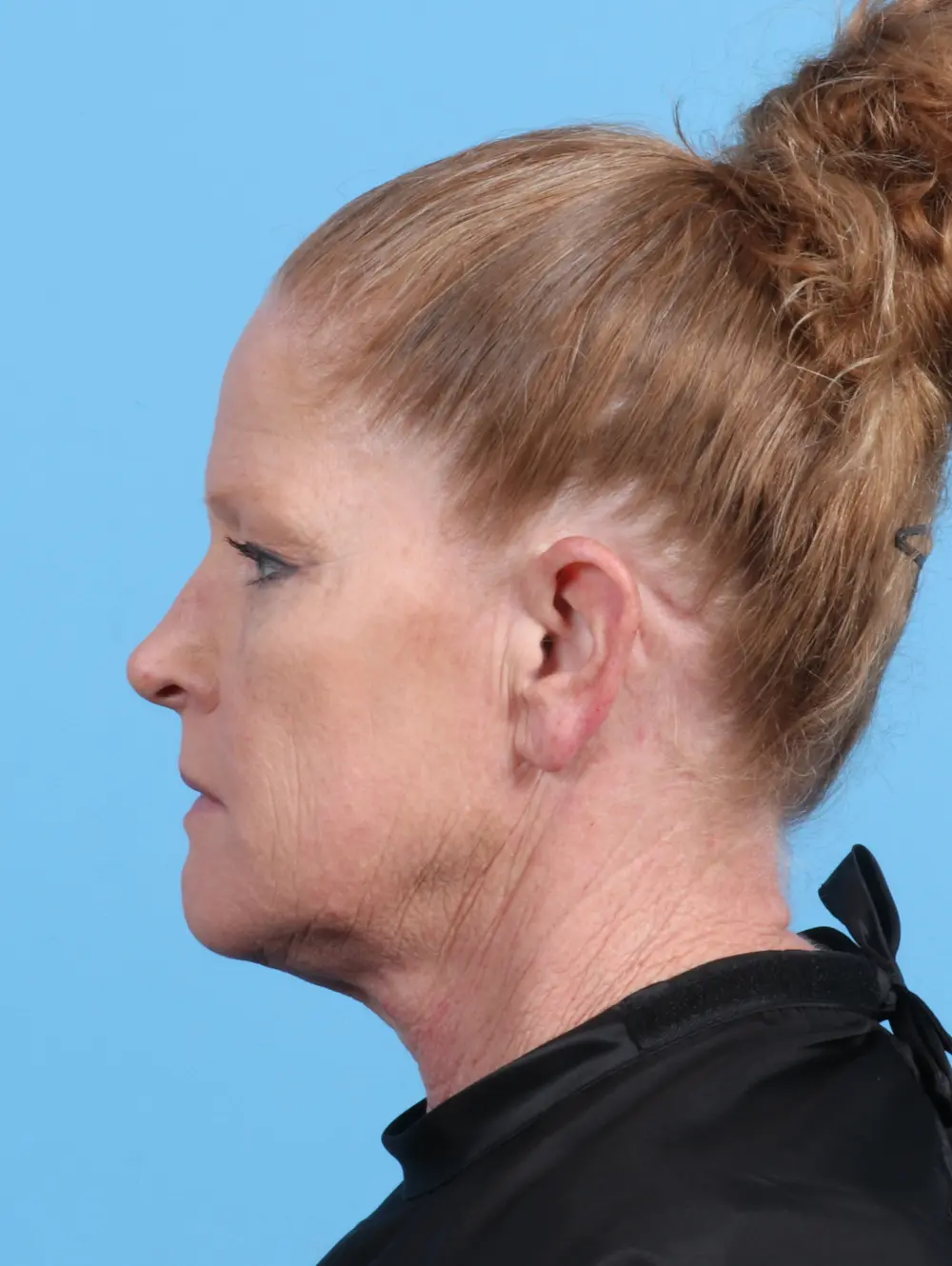 Eyelid Surgery Patient Photo - Case 24987 - before view-2