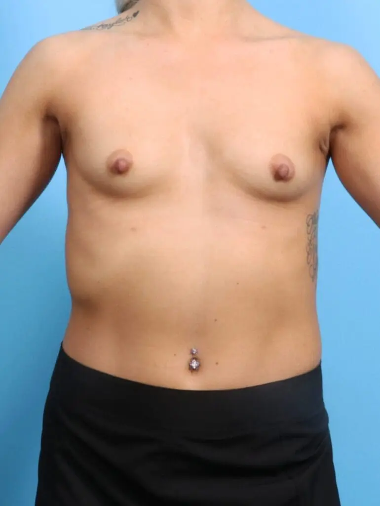 Breast Augmentation - Case 24995 - Before