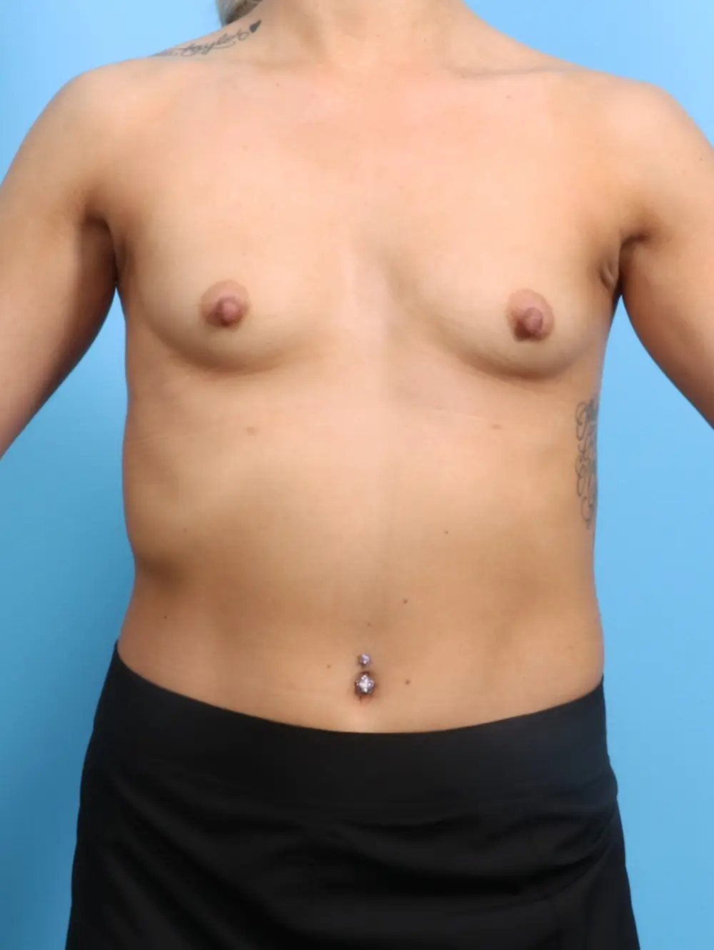 Breast Augmentation Patient Photo - Case 24995 - before view-