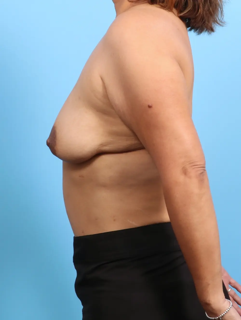 Breast Lift/Reduction with Implants Patient Photo - Case 25011 - before view-2