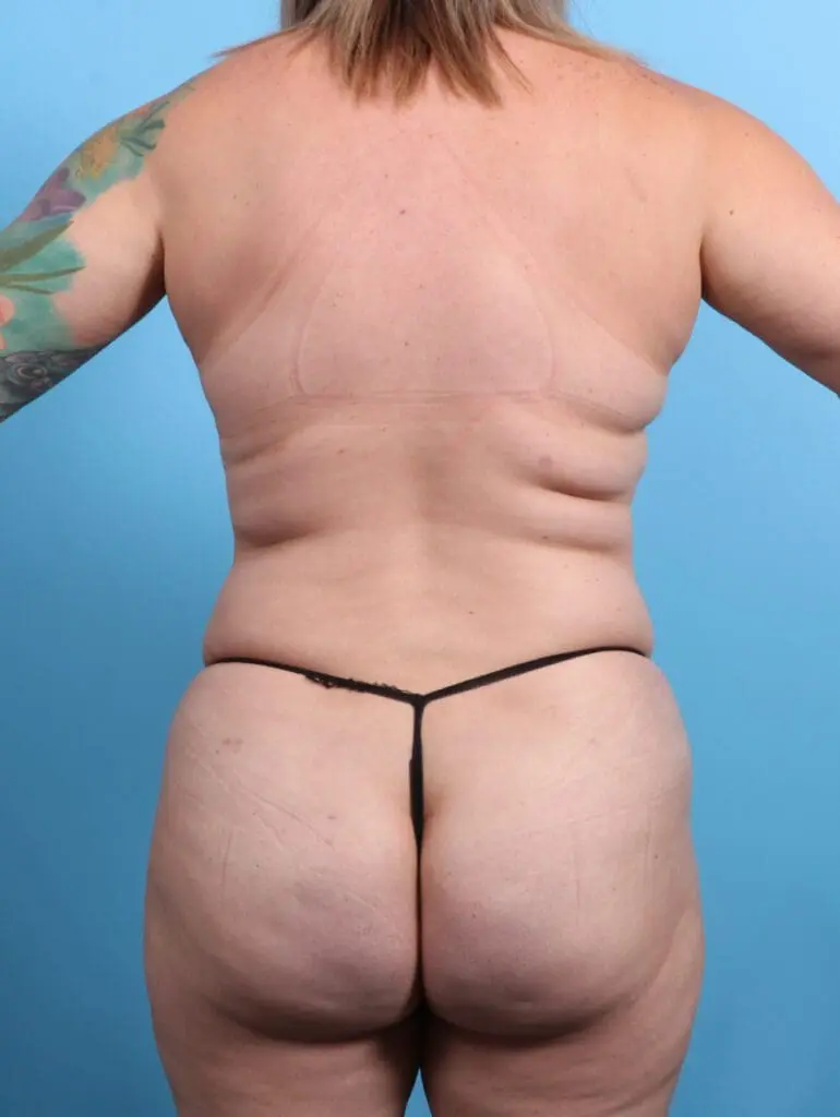 Liposuction - Case 25067 - After