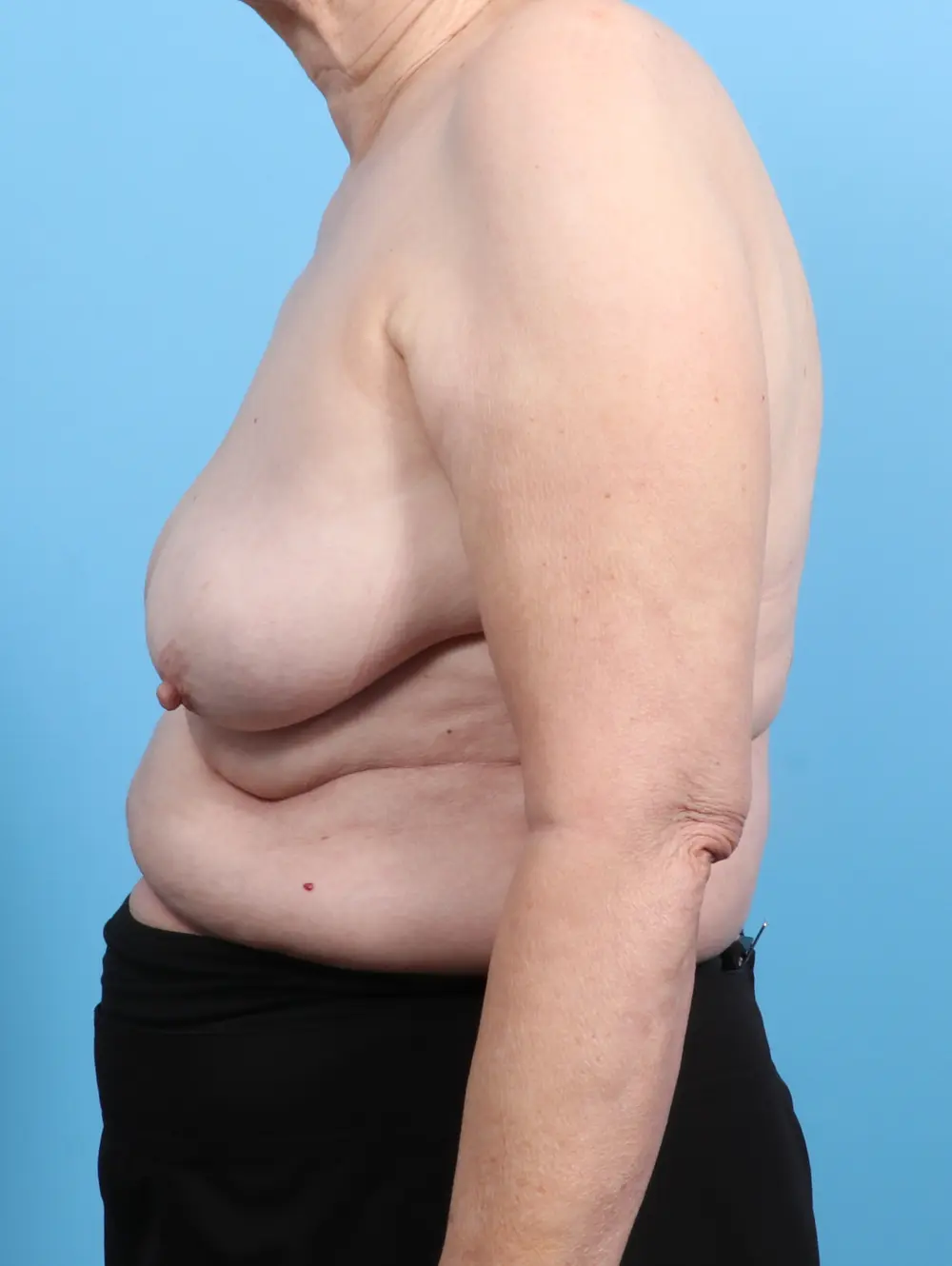 Breast Implant Removal Patient Photo - Case 25077 - after view-2