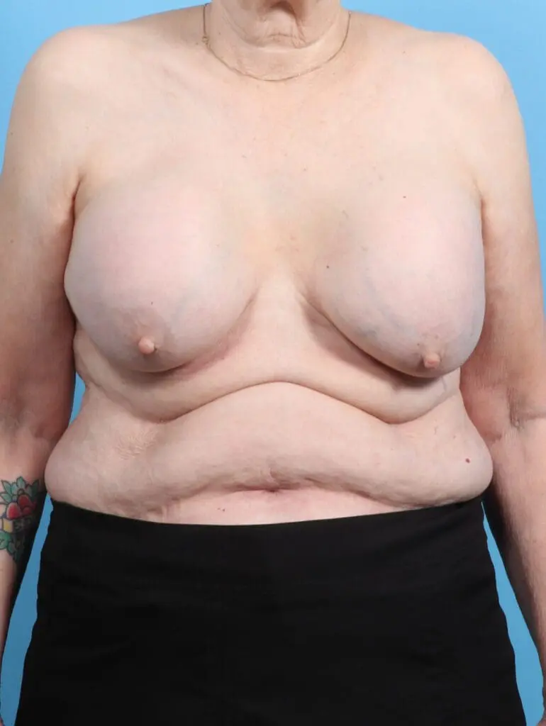 Breast Implant Removal - Case 25077 - Before