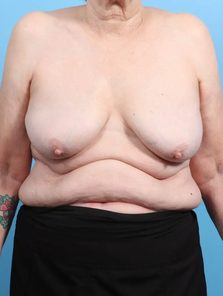 Breast Implant Removal - Case 25077 - After