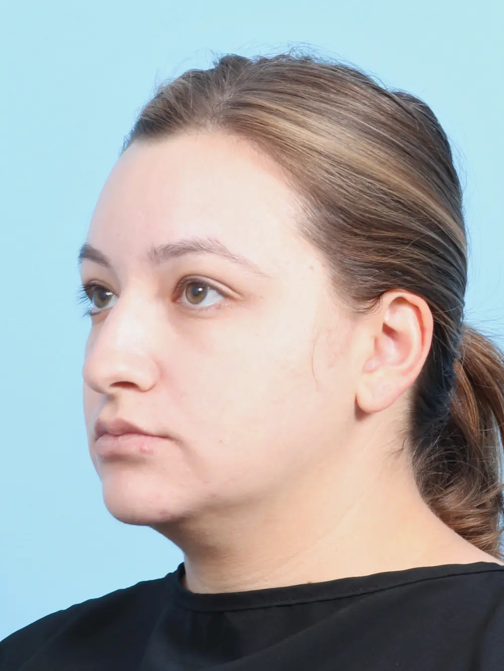 Rhinoplasty Patient Photo - Case 25085 - before view-1