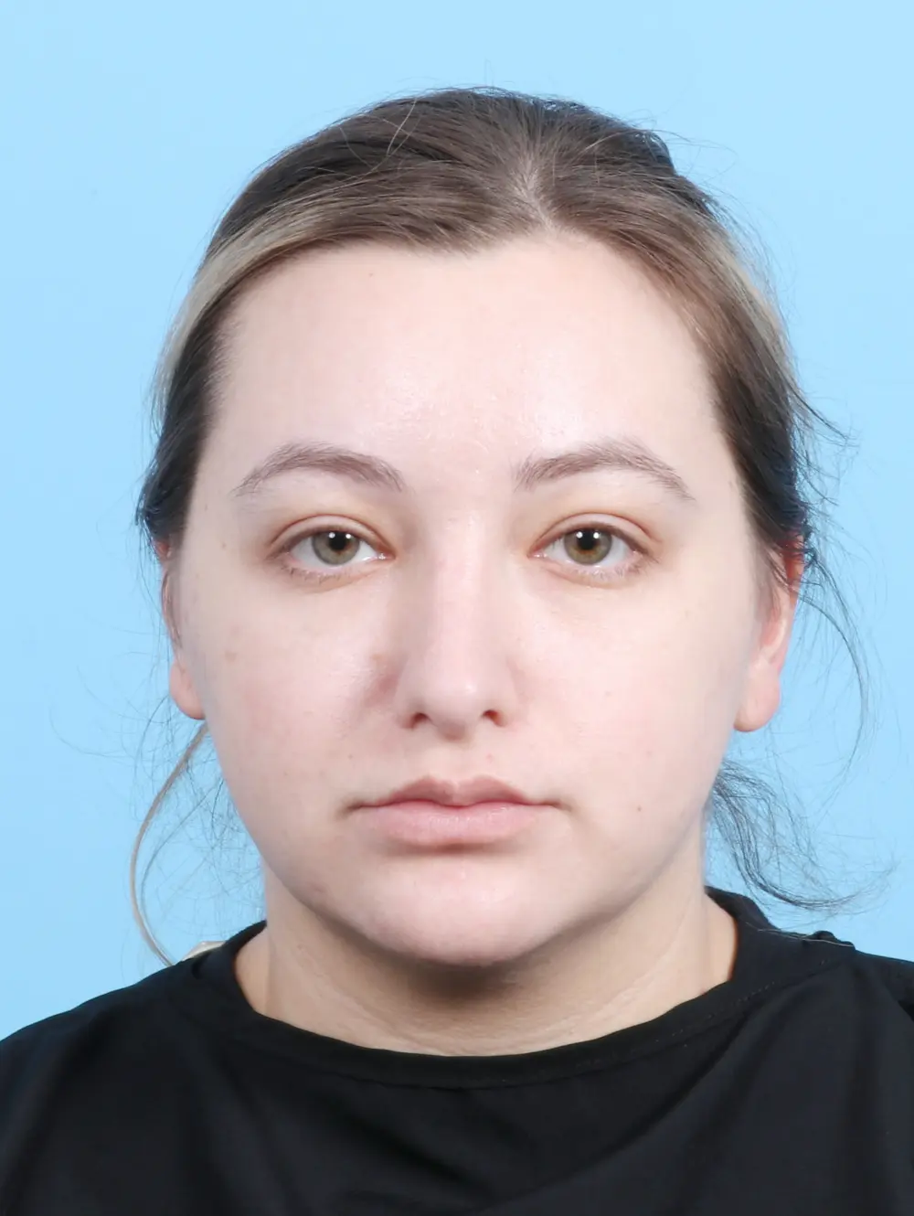 Rhinoplasty Patient Photo - Case 25085 - after view-2