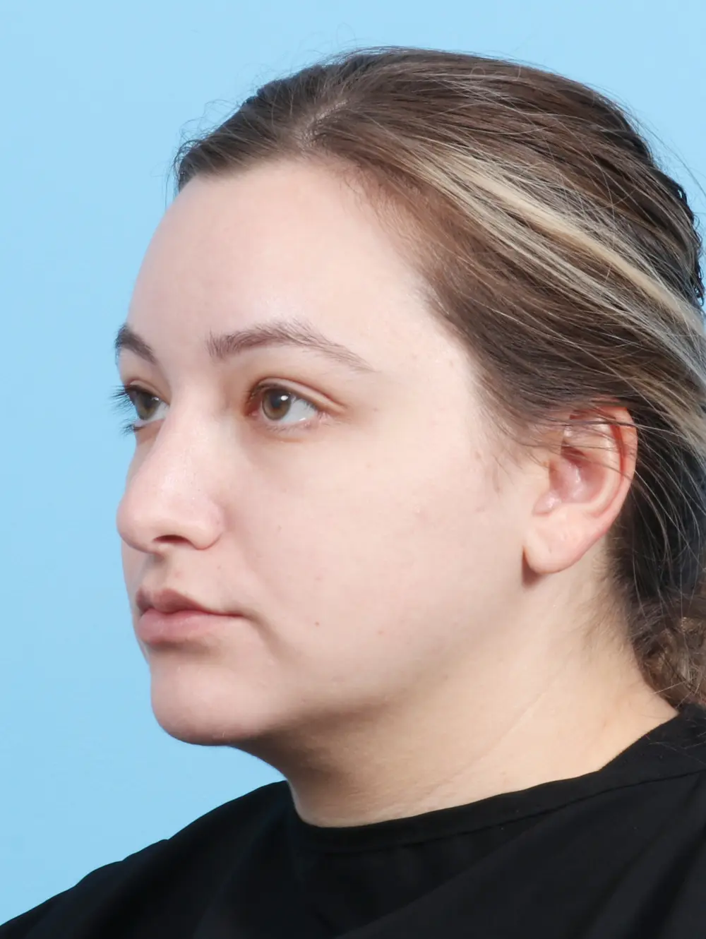Rhinoplasty Patient Photo - Case 25085 - after view-1