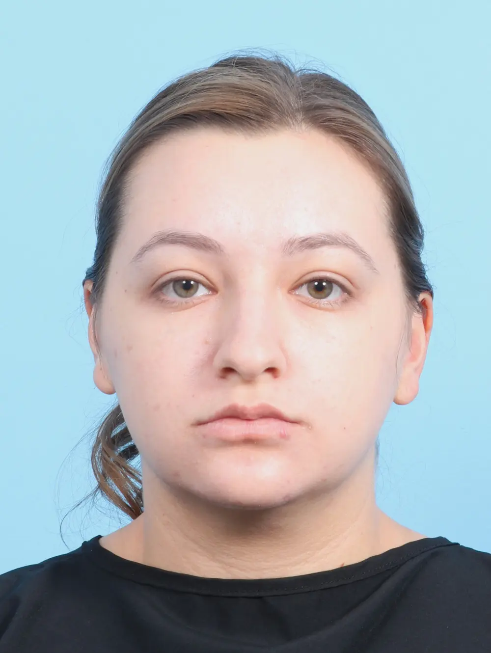 Rhinoplasty Patient Photo - Case 25085 - before view-2