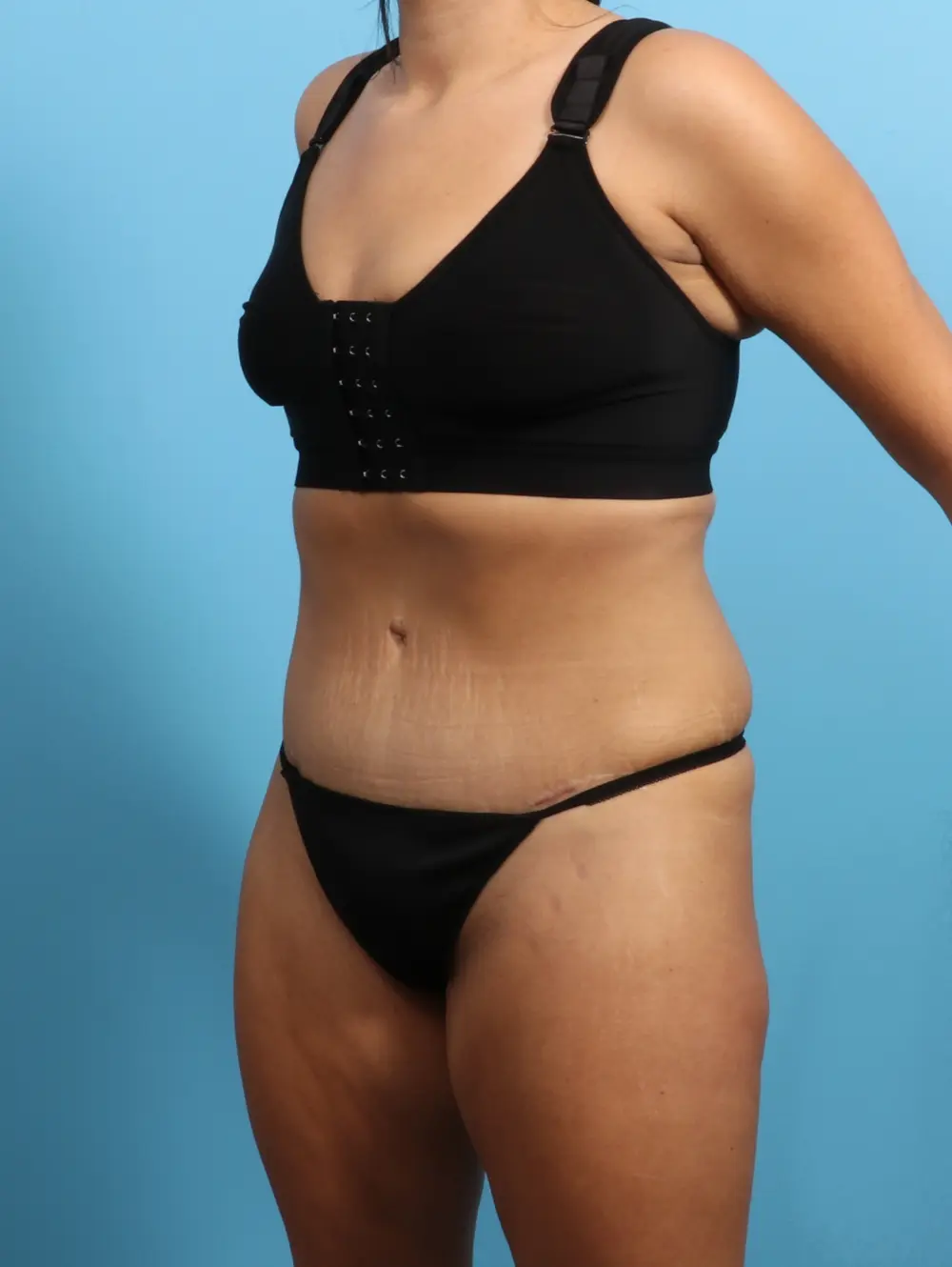 Tummy Tuck Patient Photo - Case 25149 - after view-1