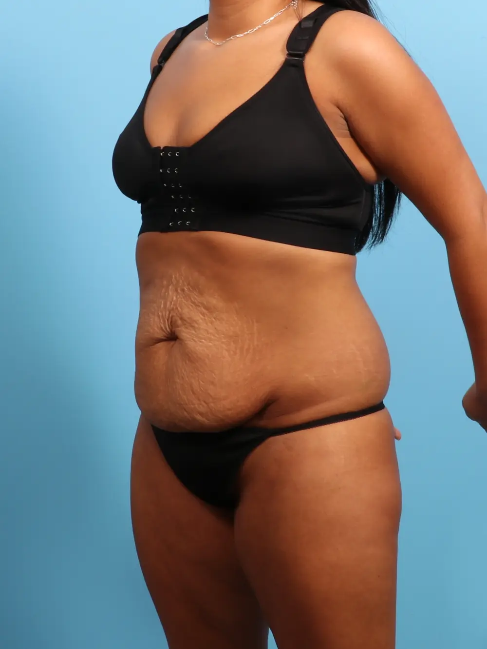 Tummy Tuck Patient Photo - Case 25149 - before view-1