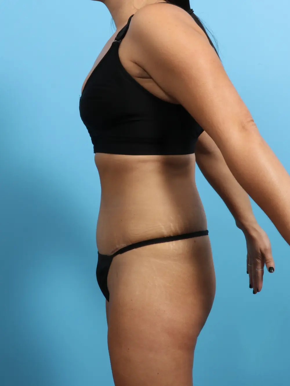 Tummy Tuck Patient Photo - Case 25149 - after view-2