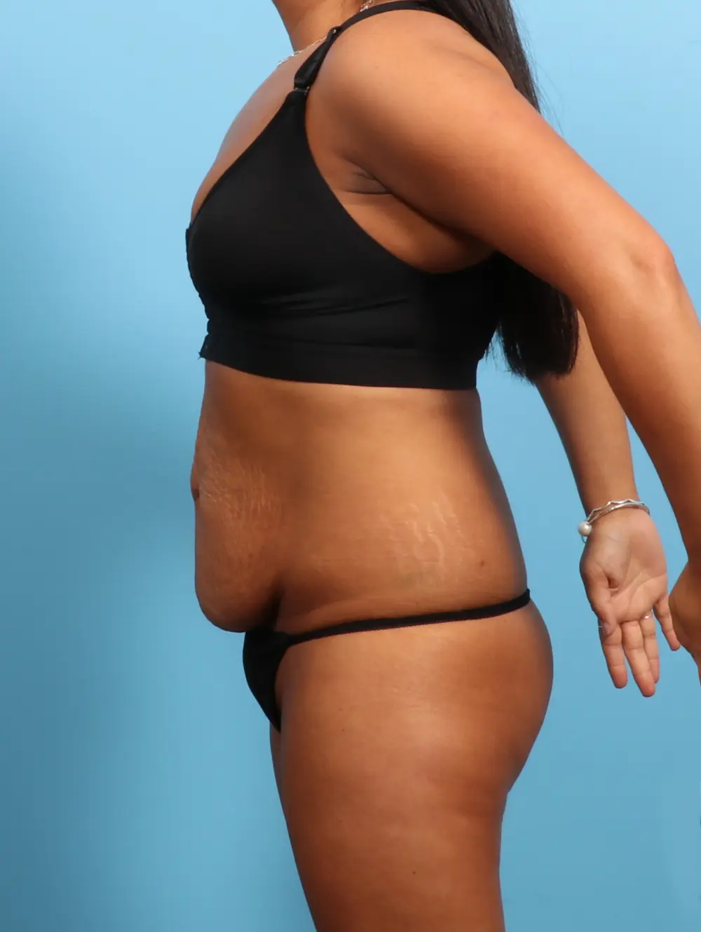 Tummy Tuck Patient Photo - Case 25149 - before view-2