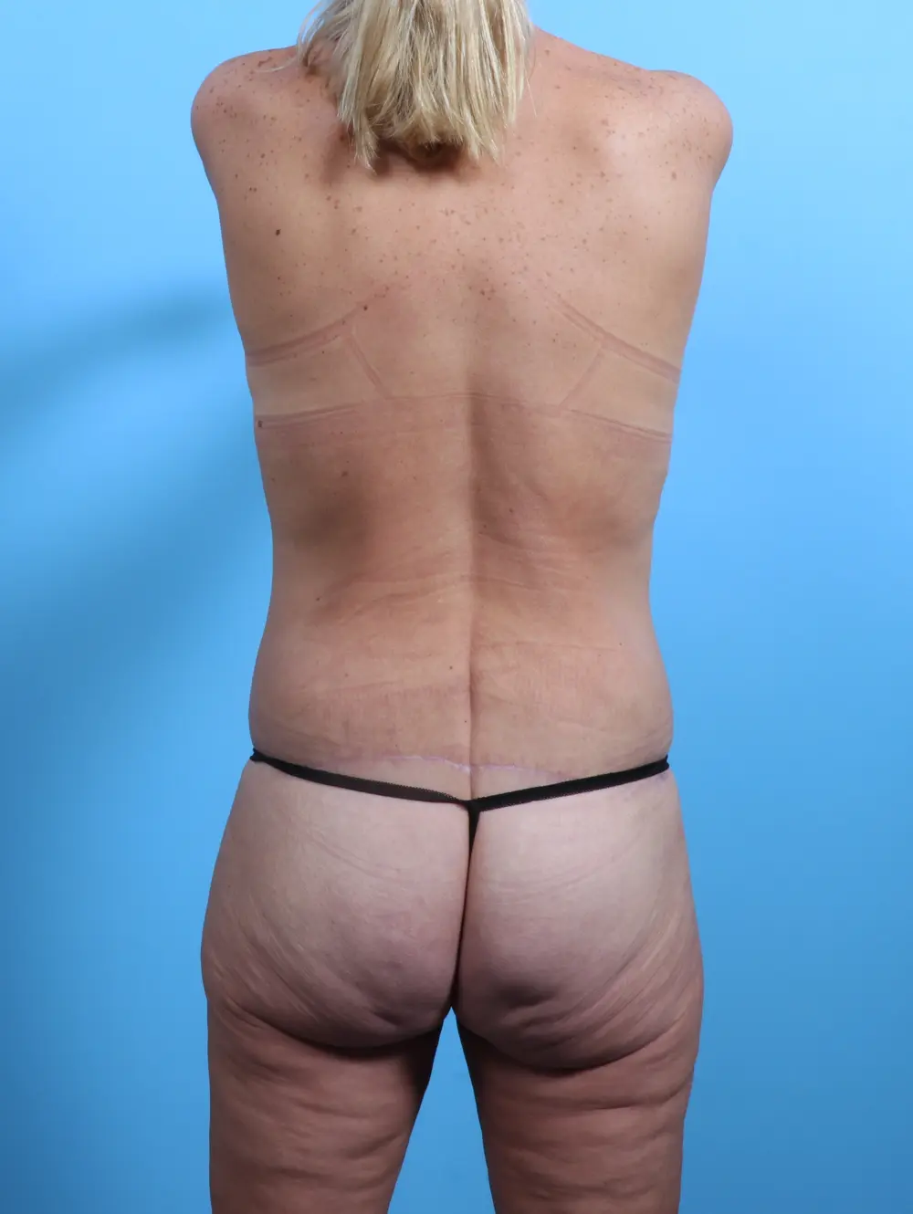 After Weight Loss Patient Photo - Case 25157 - after view-3