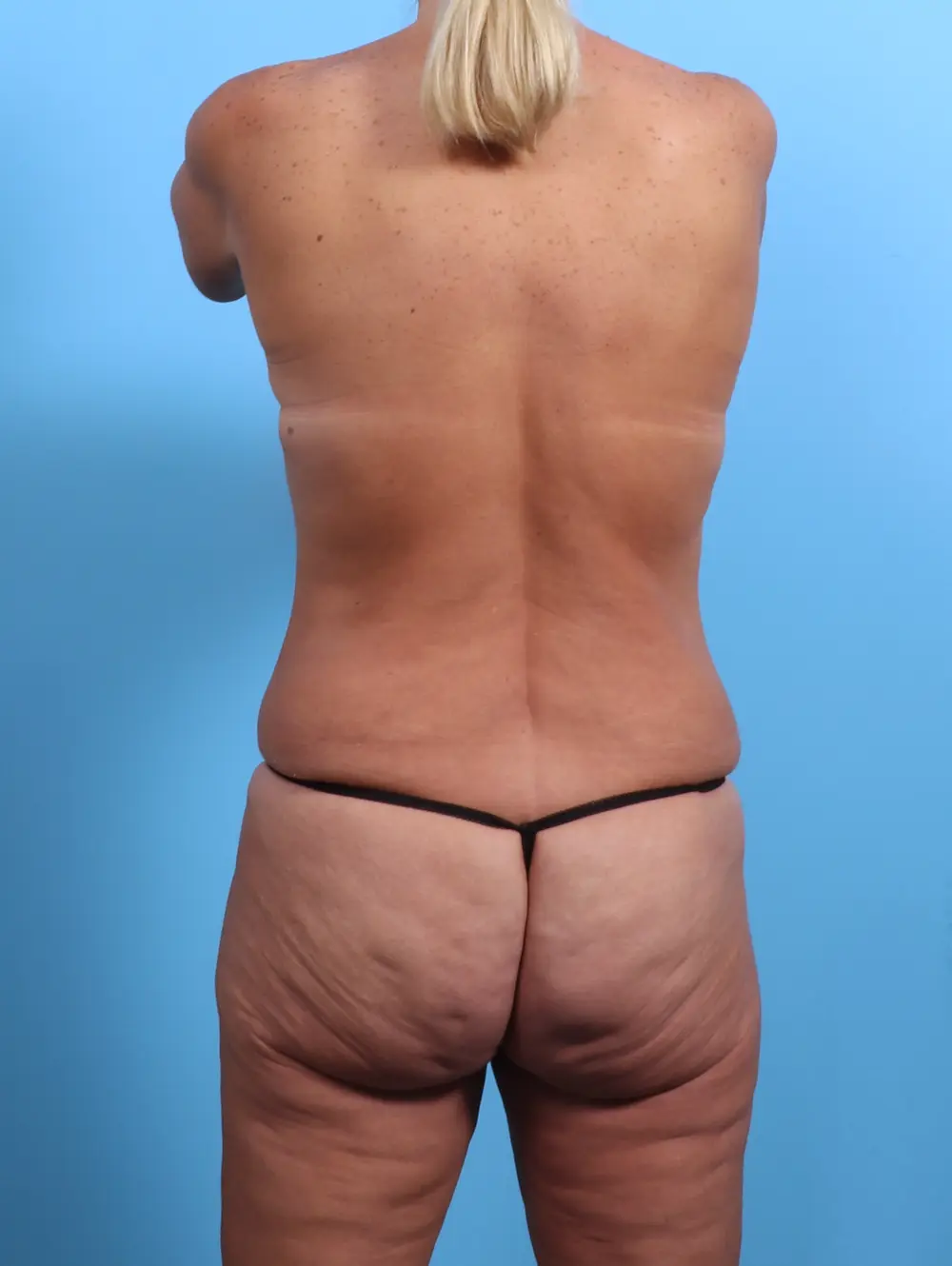 After Weight Loss Patient Photo - Case 25157 - before view-3