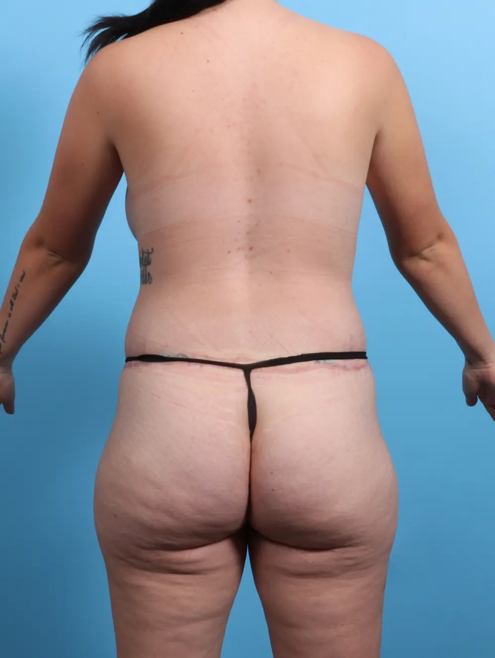 Body Lift Patient Photo - Case 25175 - after view-3