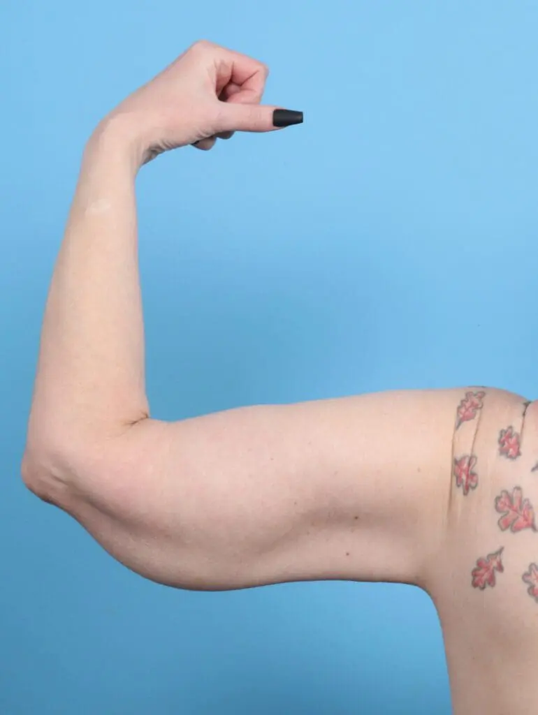 After Weight Loss - Case 25346 - After