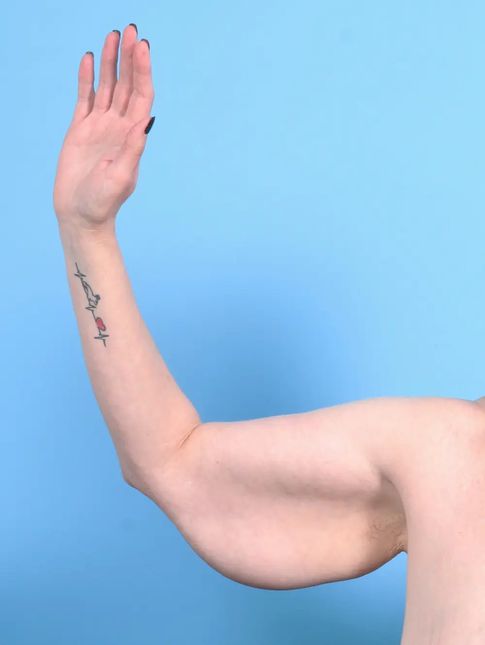 After Weight Loss Patient Photo - Case 25346 - before view-1