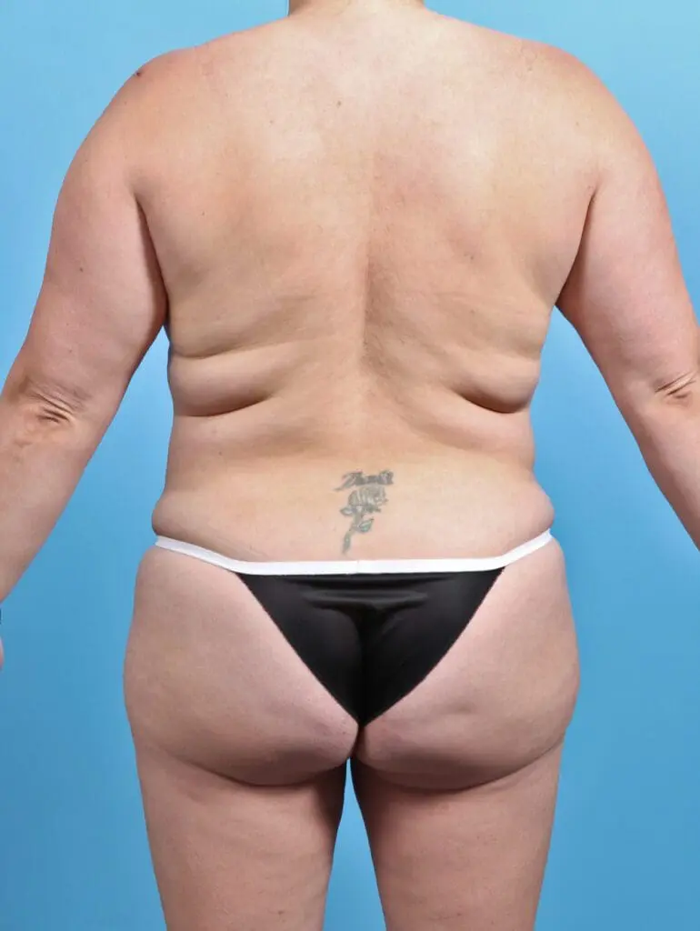 Liposuction - Case 25405 - Before