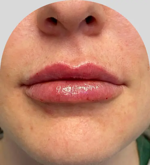Lip Fillers - Case 25419 - After