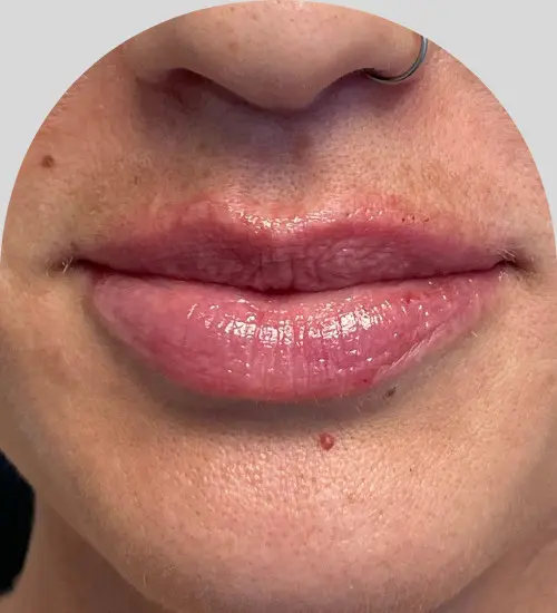 Lip Fillers - Case 25427 - After