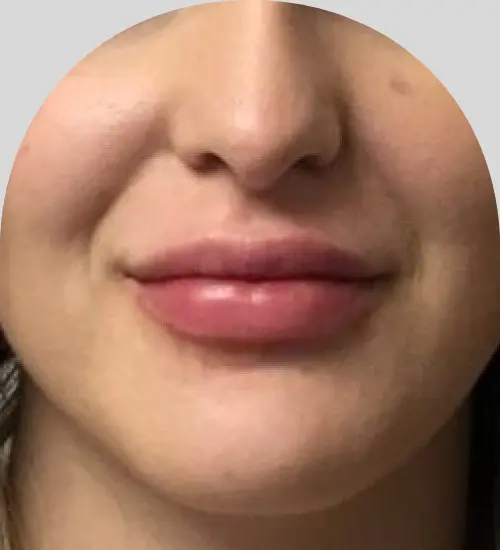 Lip Fillers - Case 25435 - After