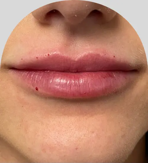 Lip Fillers - Case 25439 - After
