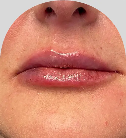 Lip Fillers - Case 25443 - After