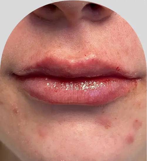 Lip Fillers - Case 25451 - After