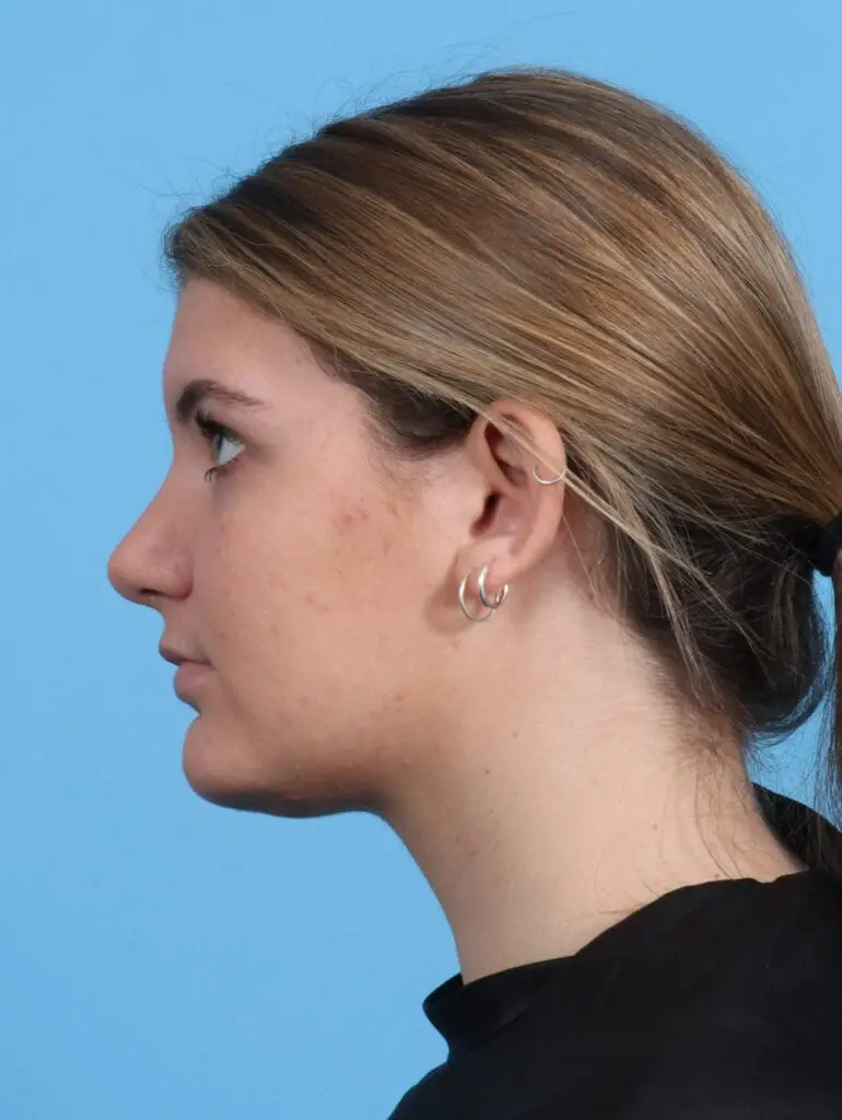Rhinoplasty - Case 25485 - After