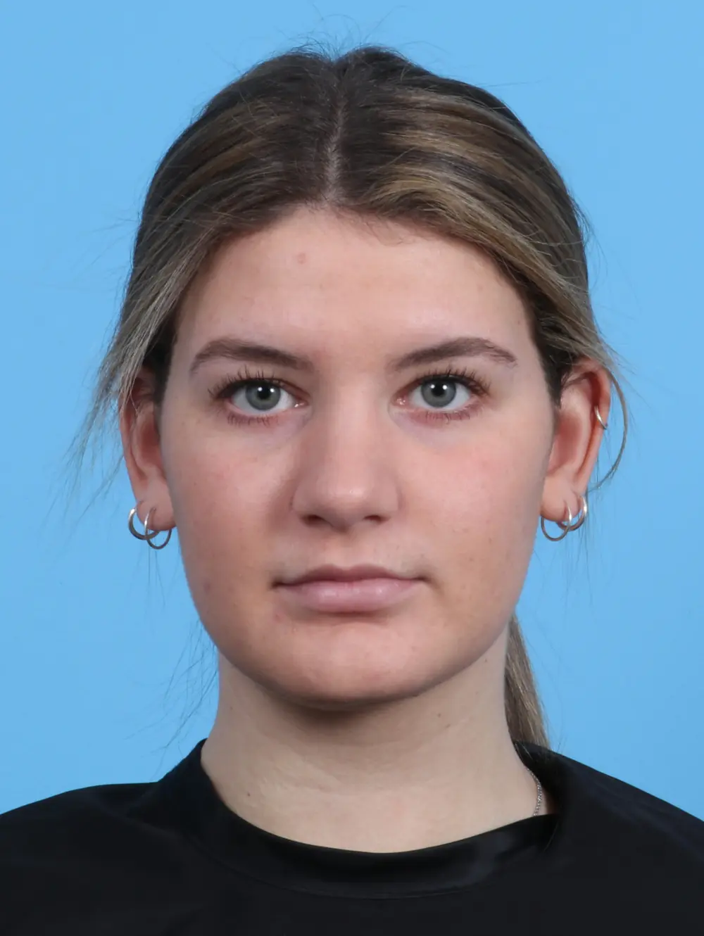 Rhinoplasty Patient Photo - Case 25485 - after view-2