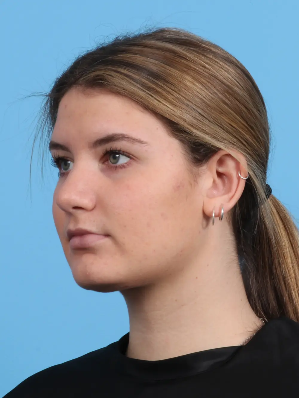 Rhinoplasty Patient Photo - Case 25485 - after view-1