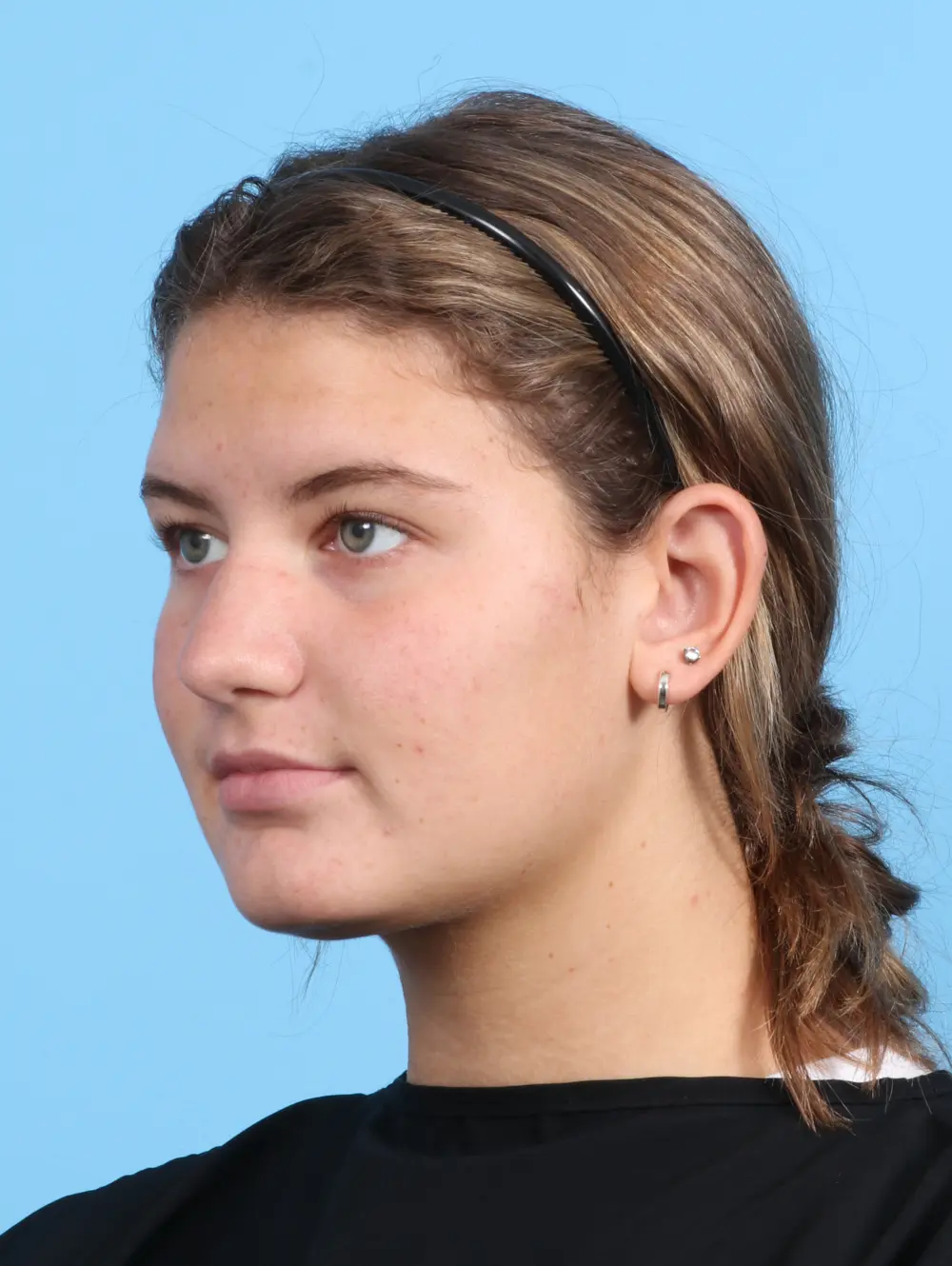 Rhinoplasty Patient Photo - Case 25485 - before view-1