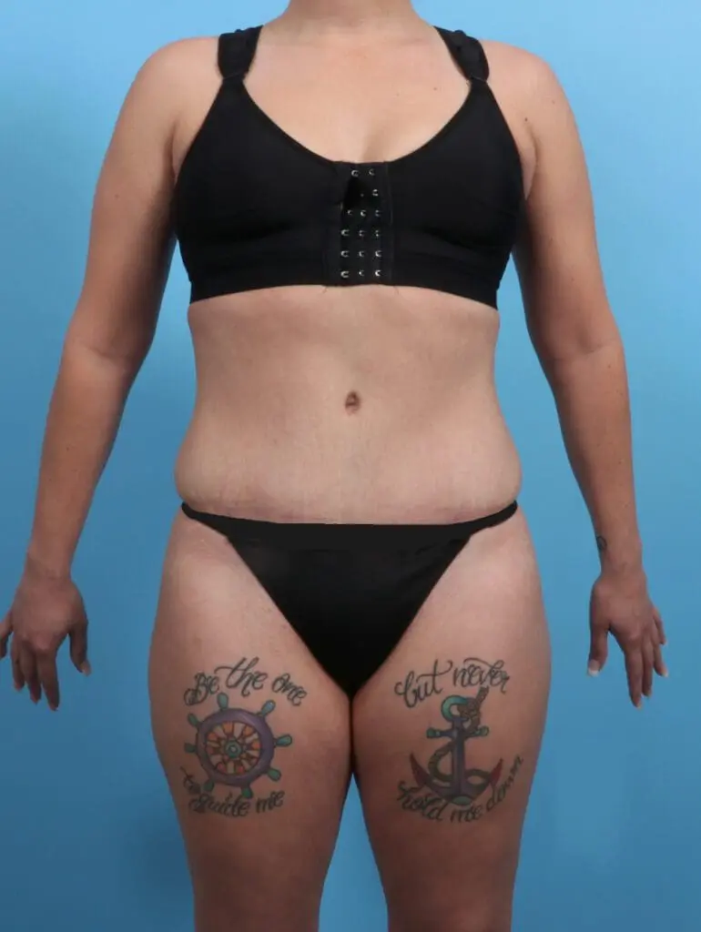 Tummy Tuck - Case 25493 - After