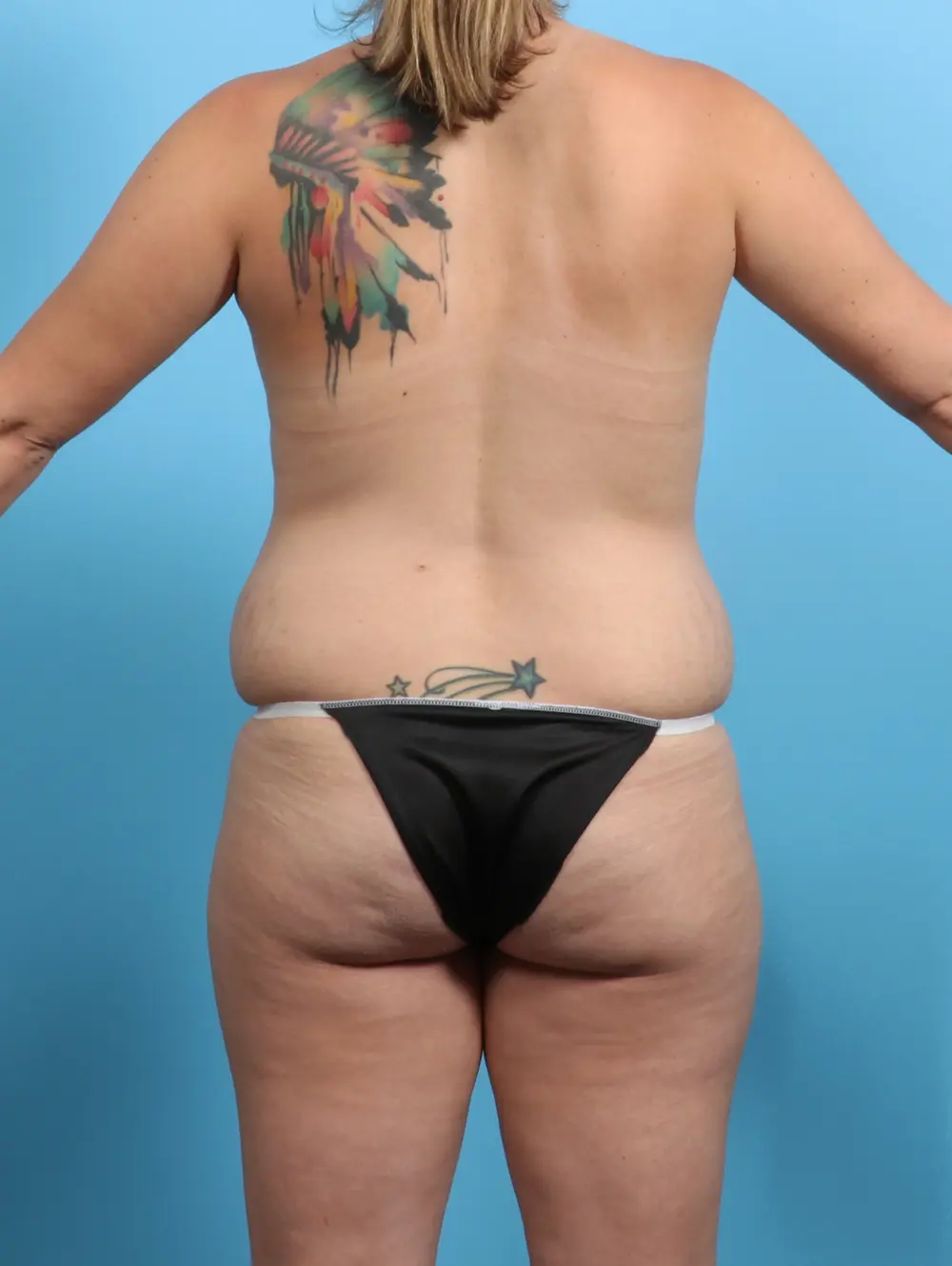 Tummy Tuck Patient Photo - Case 25493 - before view-3