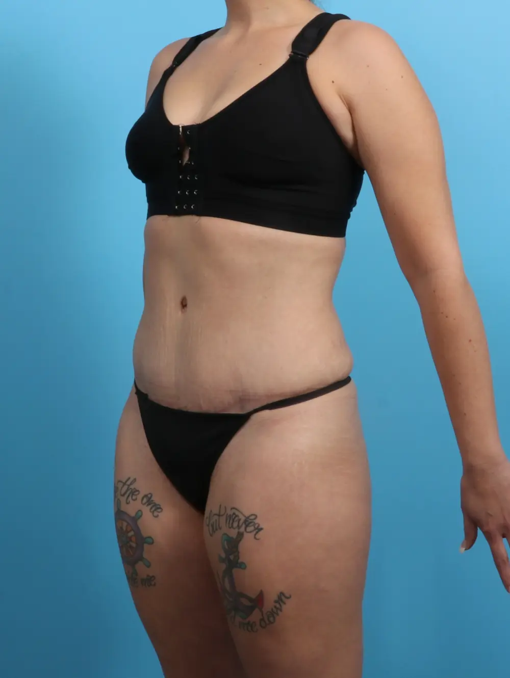 Tummy Tuck Patient Photo - Case 25493 - after view-1