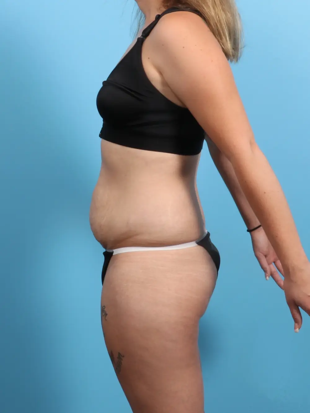 Tummy Tuck Patient Photo - Case 25493 - before view-2