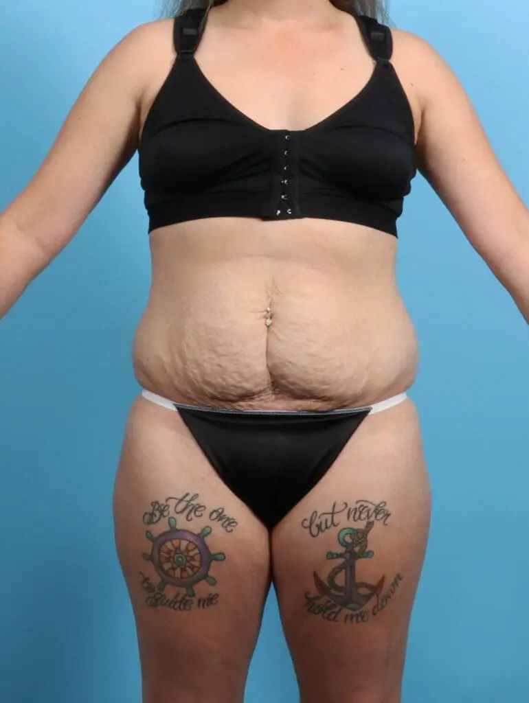 Tummy Tuck - Case 25493 - Before