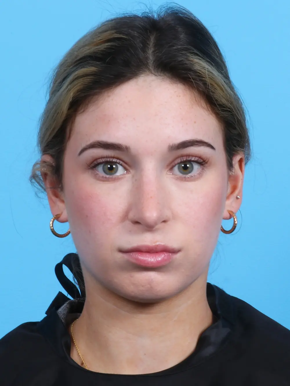 Rhinoplasty Patient Photo - Case 25503 - after view-2