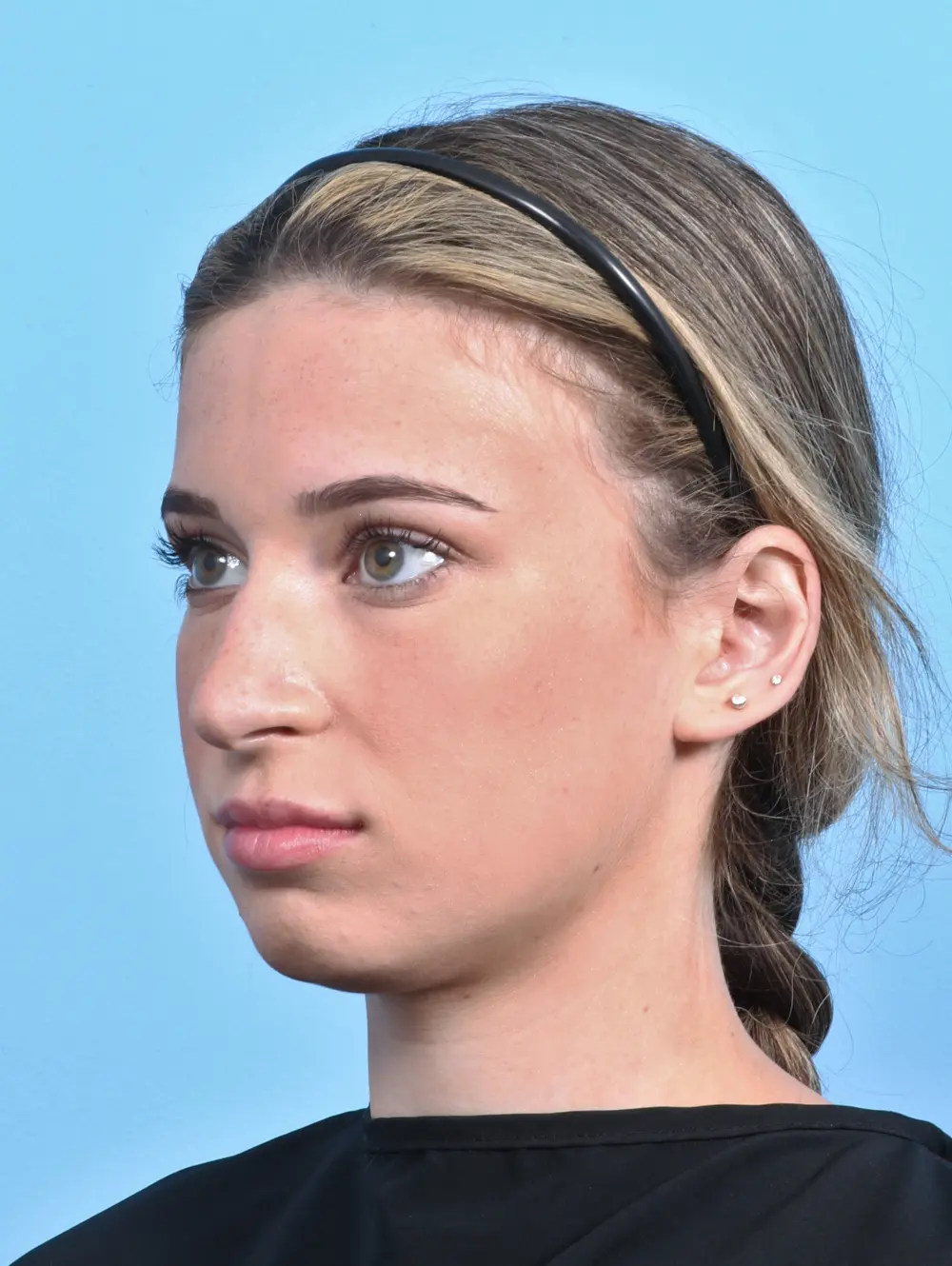 Rhinoplasty Patient Photo - Case 25503 - before view-1