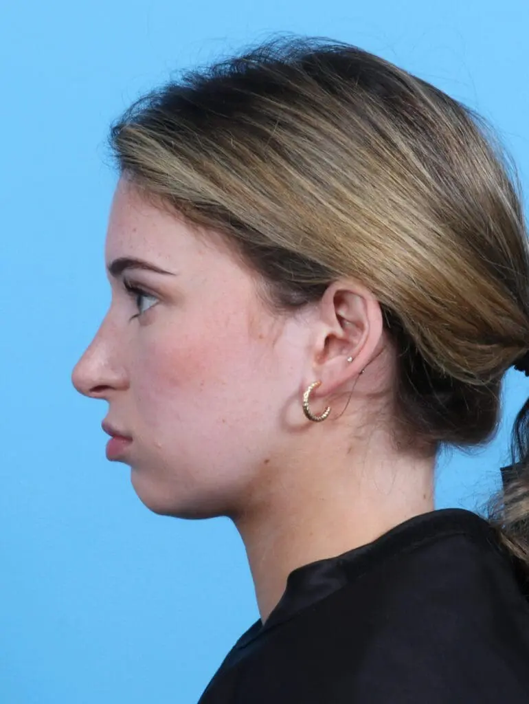 Rhinoplasty - Case 25503 - After