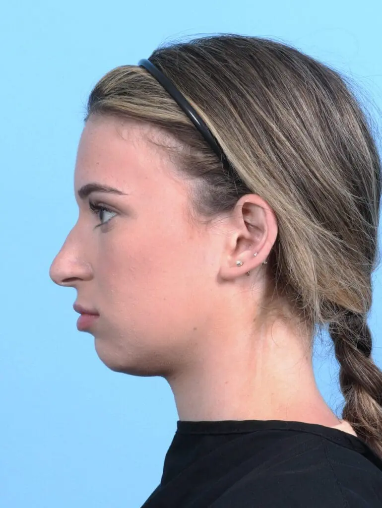 Rhinoplasty - Case 25503 - Before