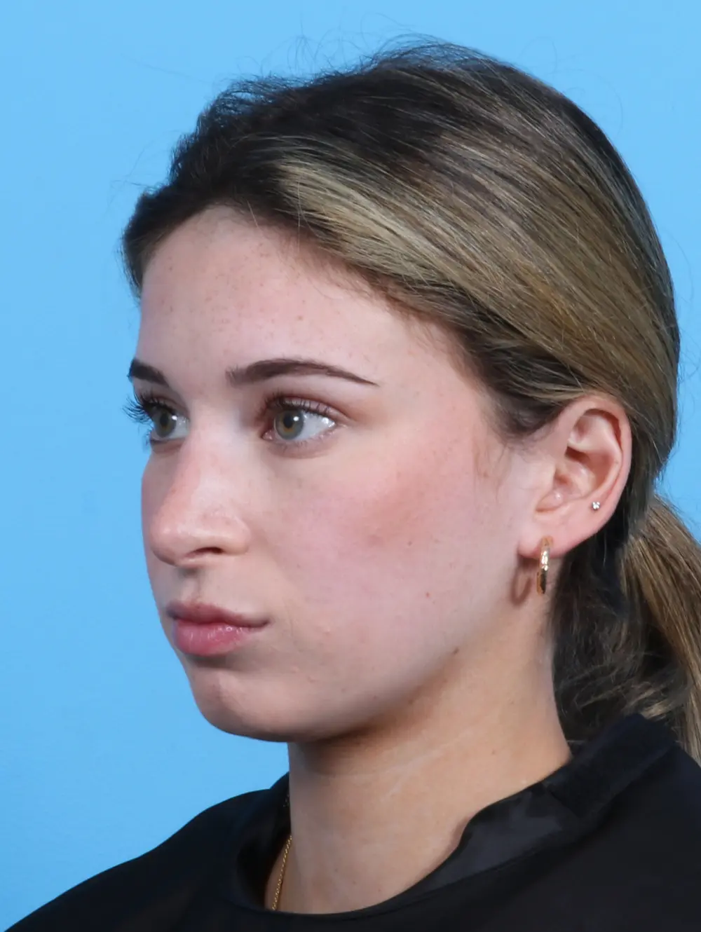 Rhinoplasty Patient Photo - Case 25503 - after view-1