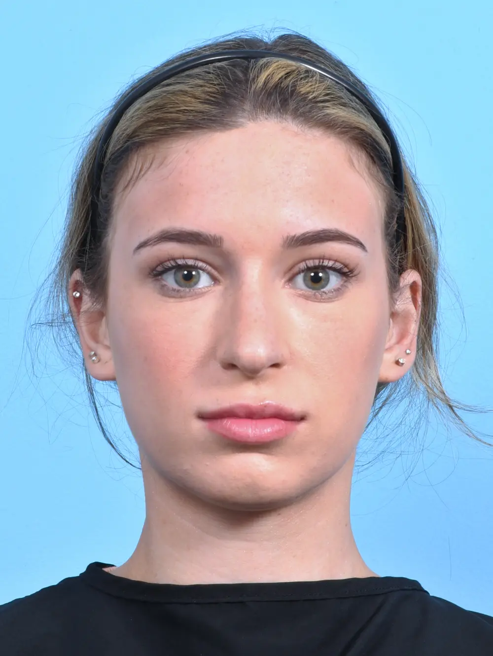 Rhinoplasty Patient Photo - Case 25503 - before view-2