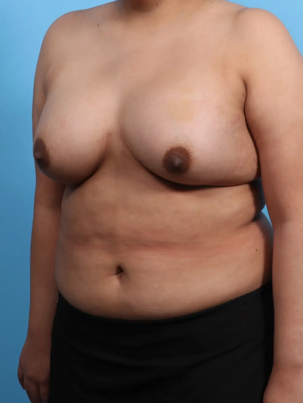 Breast Augmentation Patient Photo - Case 25536 - after view-1