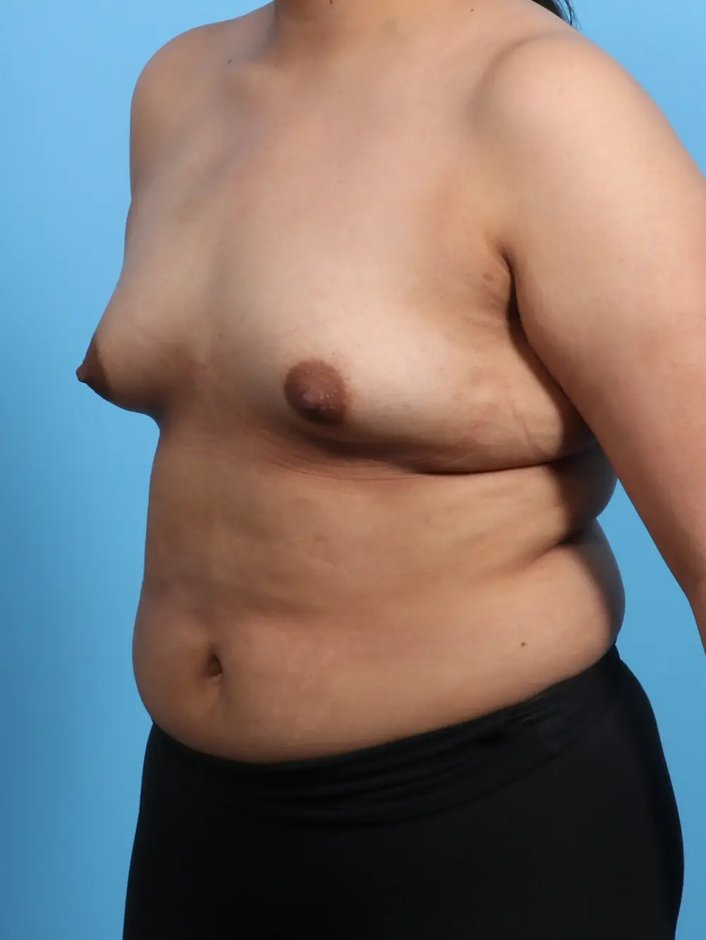 Breast Augmentation Patient Photo - Case 25536 - before view-1