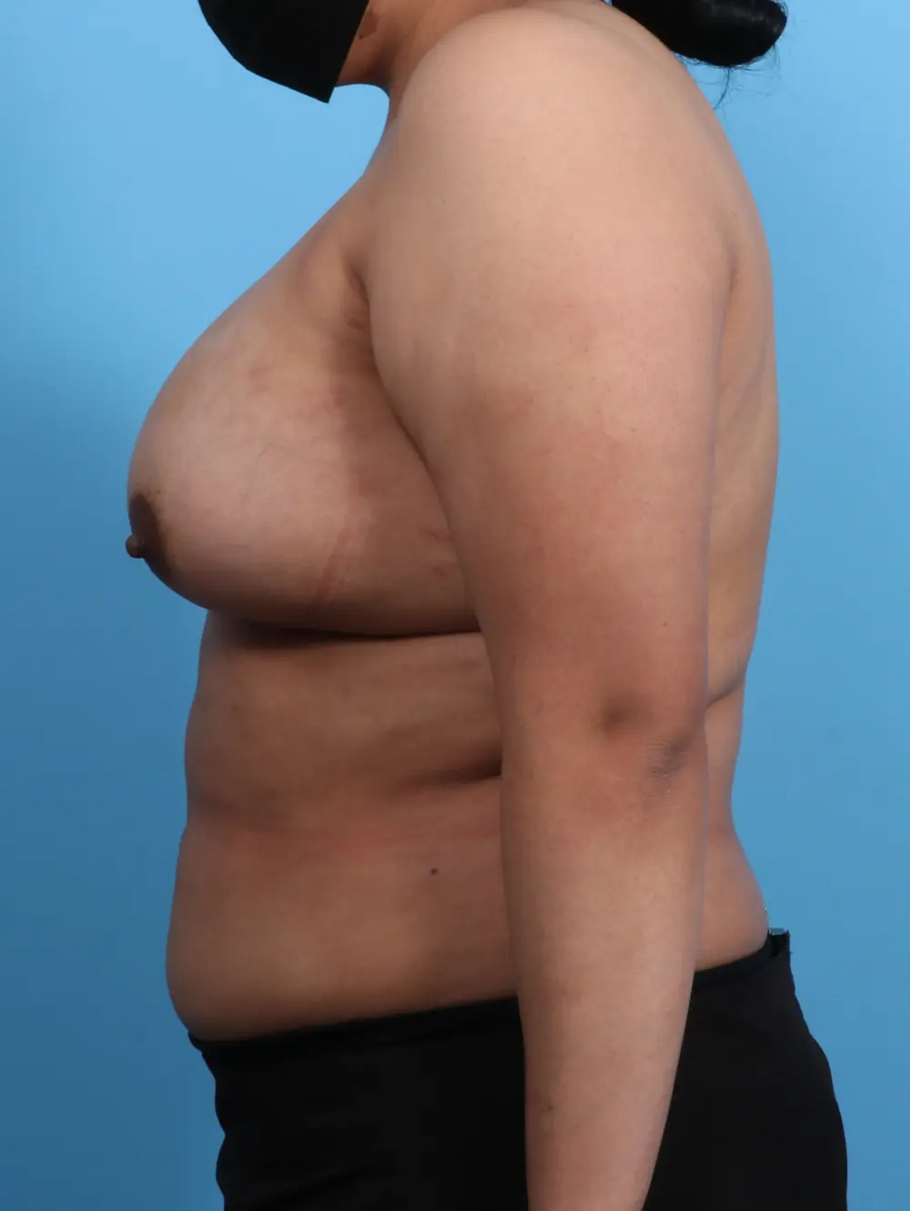 Breast Augmentation Patient Photo - Case 25536 - after view-2