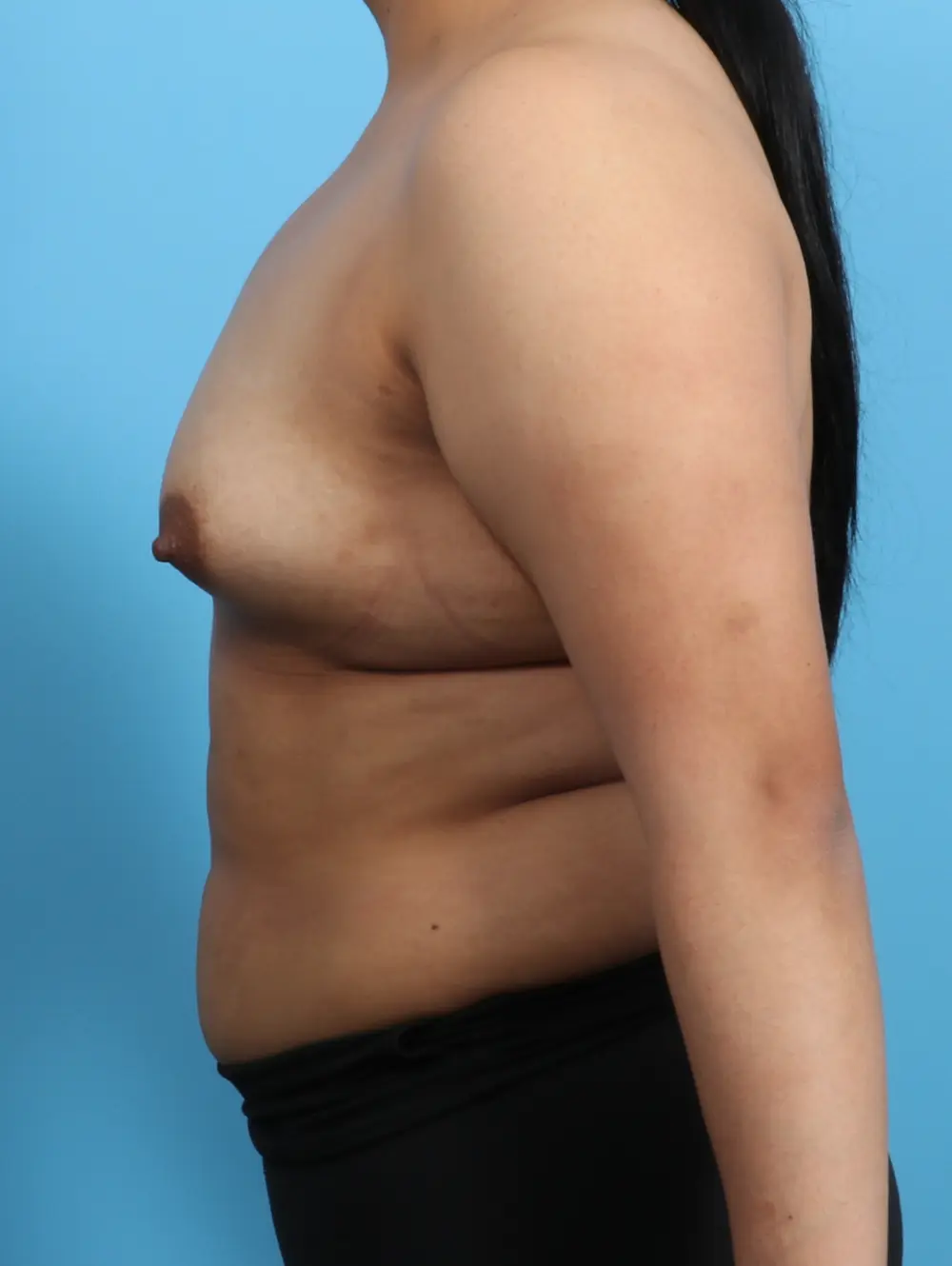 Breast Augmentation Patient Photo - Case 25536 - before view-2