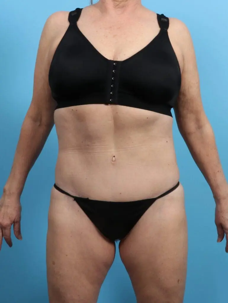 Body Lift - Case 25585 - After