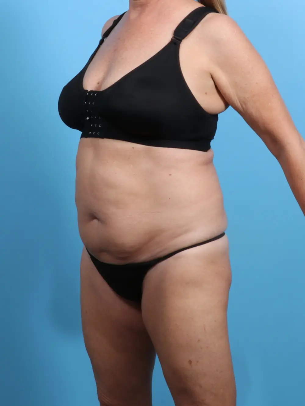 Body Lift Patient Photo - Case 25585 - before view-1