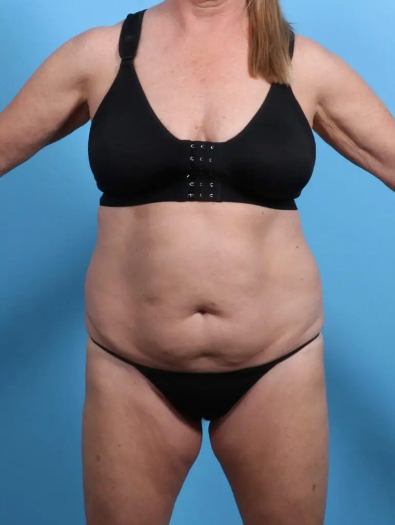 Body Lift - Case 25585 - Before